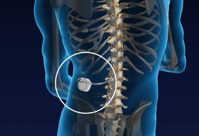 PRIMEIRA DE MINAS EM NEUROESTIMULAÇÃO PERIFÉRICA NO TRATAMENTO DE NEURALGIA PÓS-HERPÉTICA